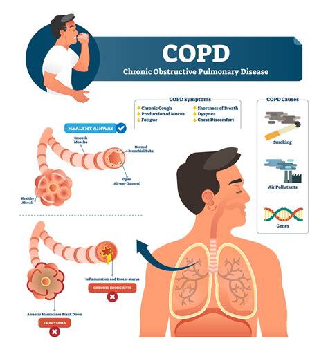 copf|Early Warning Signs of COPD 